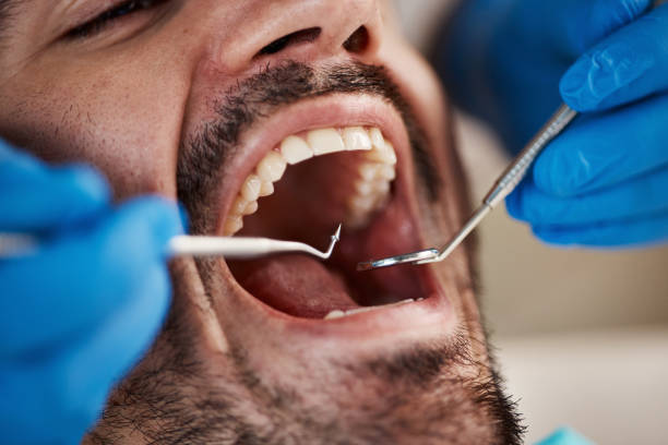 Best Emergency Wisdom Teeth Removal in Corning, CA